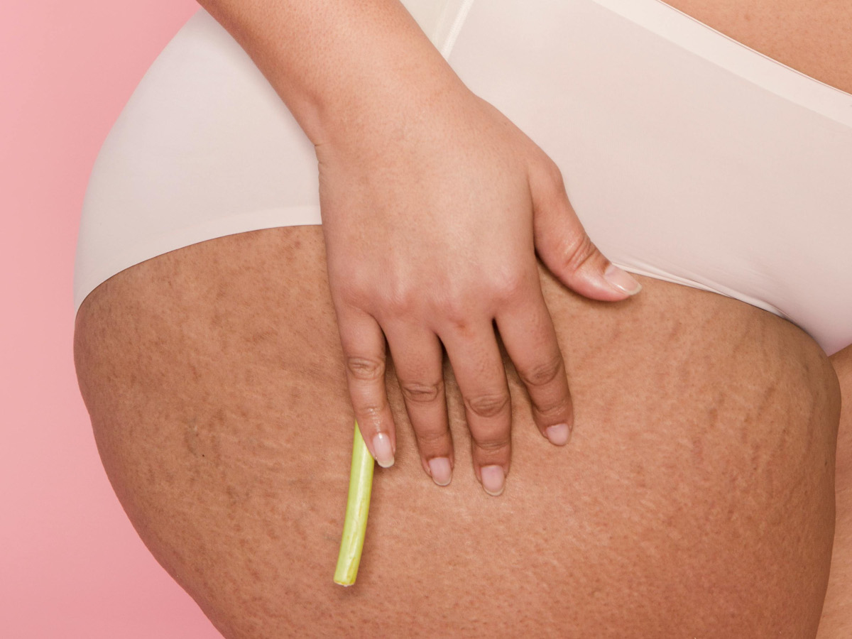 Sintomi principali del lipedema da non ignorare